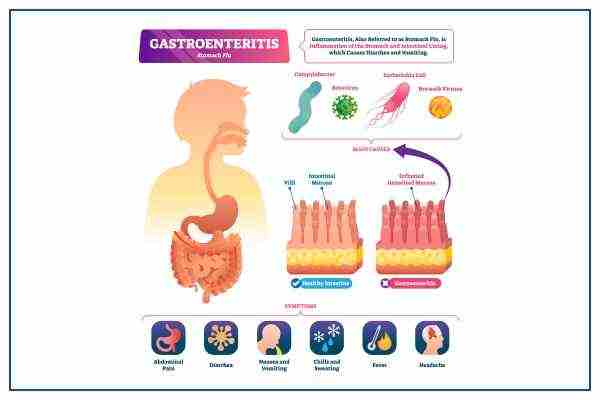 gastroenteritis symptoms