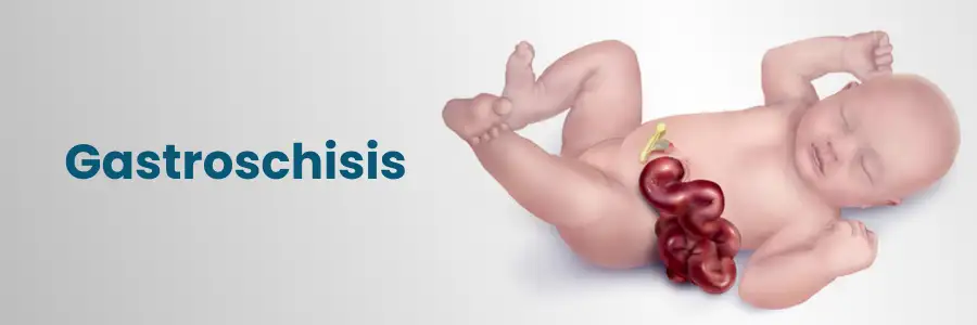 Gastroschisis