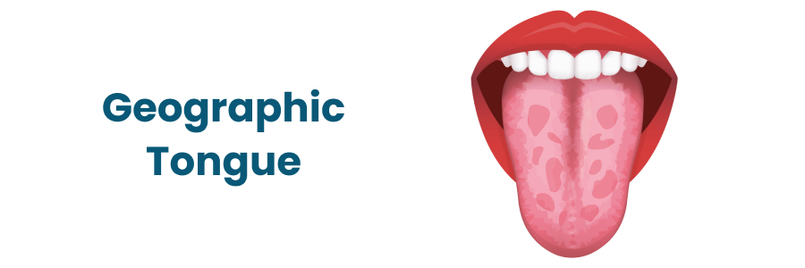 Geographic Tongue