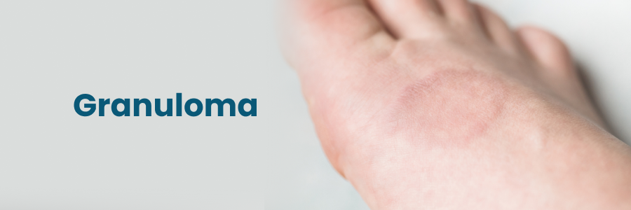 Granuloma