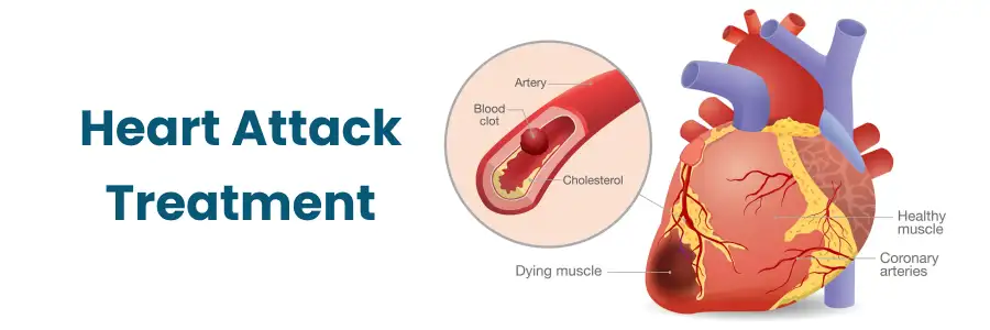 Heart Attack Treatment in Begumpet