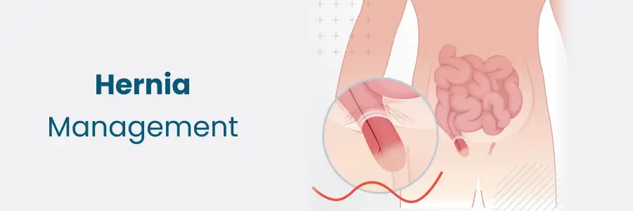 Hernia Management in Begumpet