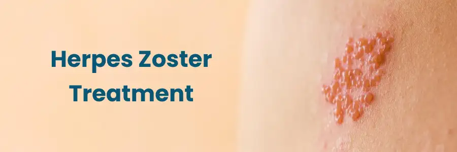 Herpes Zoster Treatment in Begumpet