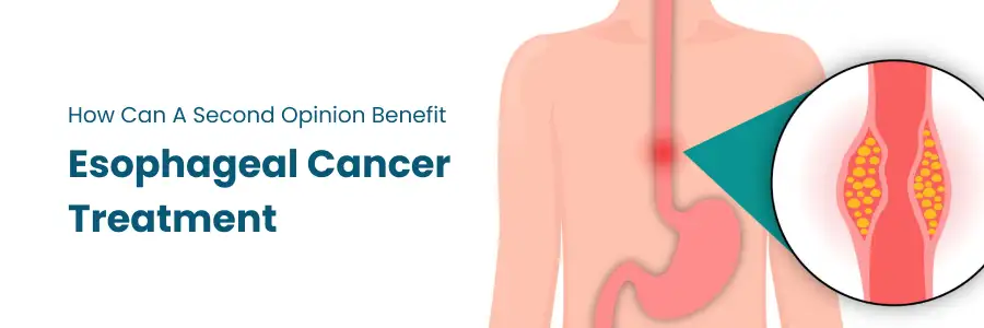 How a Second Opinion Can Benefit Esophageal Cancer Treatment