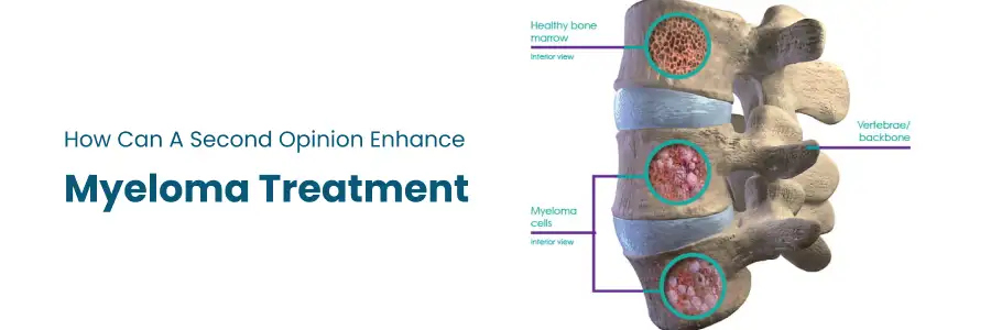 How a Second Opinion Can Enhance Myeloma Treatment
