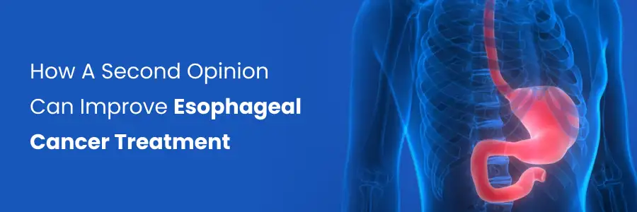How a Second Opinion Can Improve Esophageal Cancer Treatment