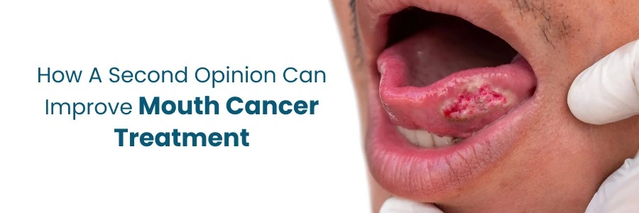 Improve Mouth Cancer Treatment with Second Opinion