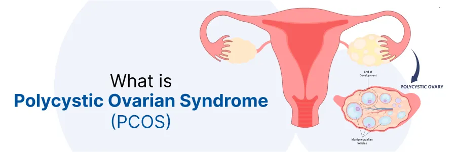 How to Get Pregnant with PCOS