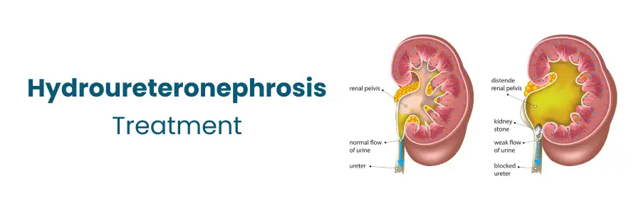 Hydroureteronephrosis Treatment