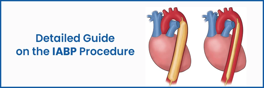 Detailed Guide on the IABP Procedure
