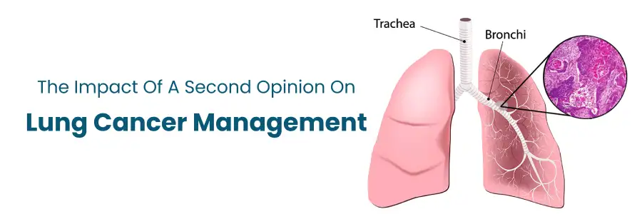 Second Opinion on Lung Cancer Management