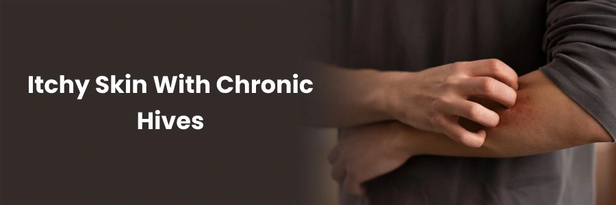 Effective Itchy Skin Relief for Chronic Hives