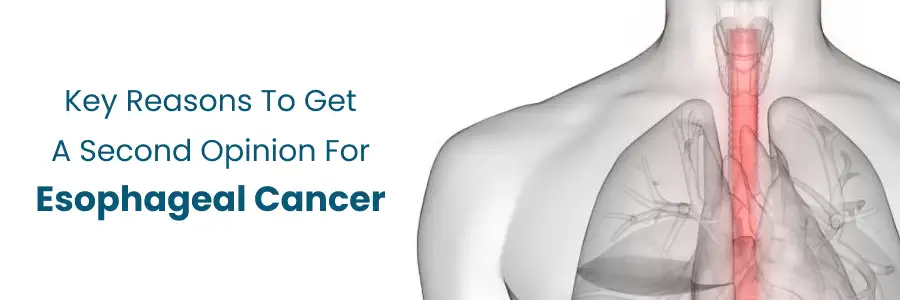 Key Reasons to Seek a Second Opinion for Esophageal Cancer