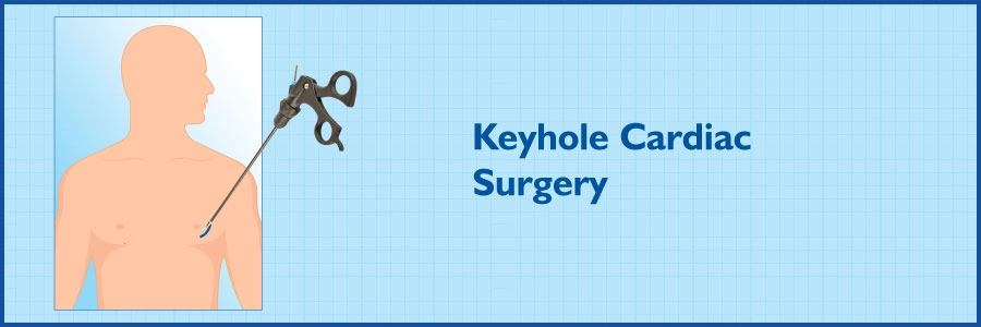 कीहोल कार्डिएक सर्जरी (मिनिमल इनवेसिव कार्डियक सर्जरी) (एमआईसीएस)