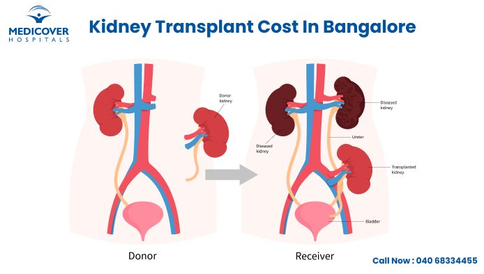 Cost of Kidney Transplant in Bangalore