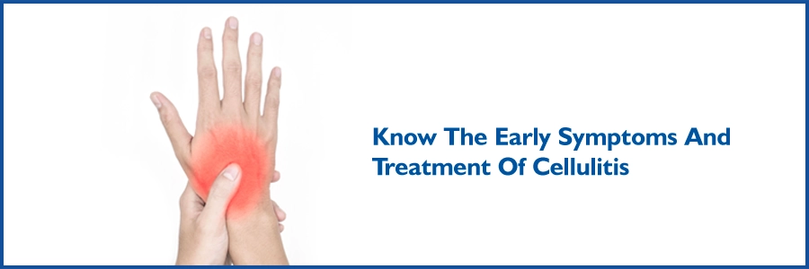 Know The Early Symptoms And Treatment Of Cellulitis