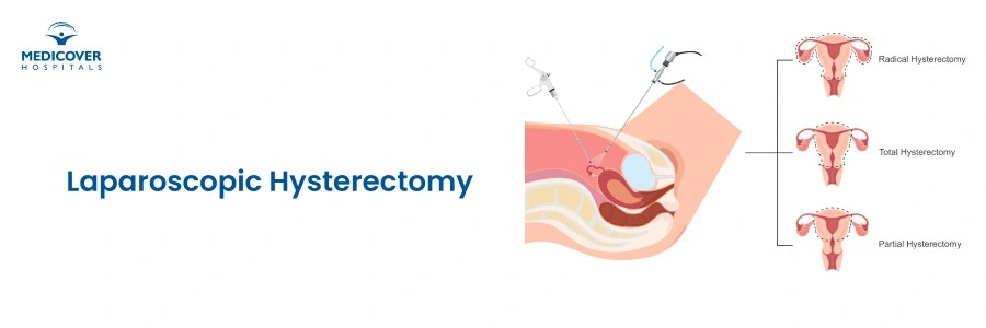 Laparoscopic Hysterectomy in Chandanagar | Minimally Invasive Uterus Removal