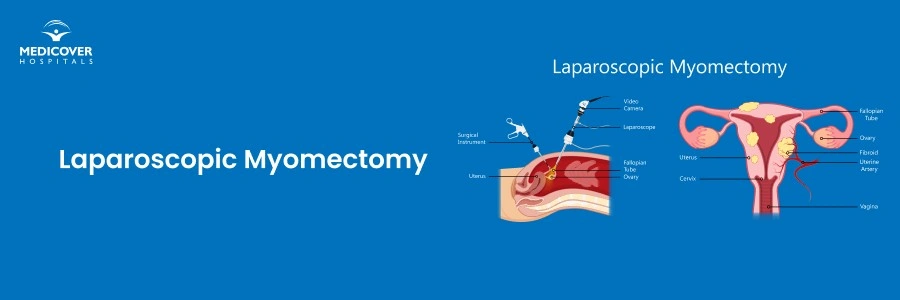 Laparoscopic Myomectomy in Chandanagar | Fibroid Removal