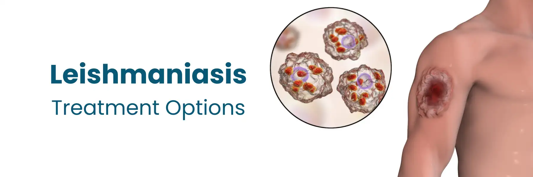 leishmaniasis treatment options