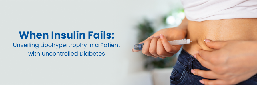 Lipohypertrophy in a Patient with Uncontrolled Diabetes