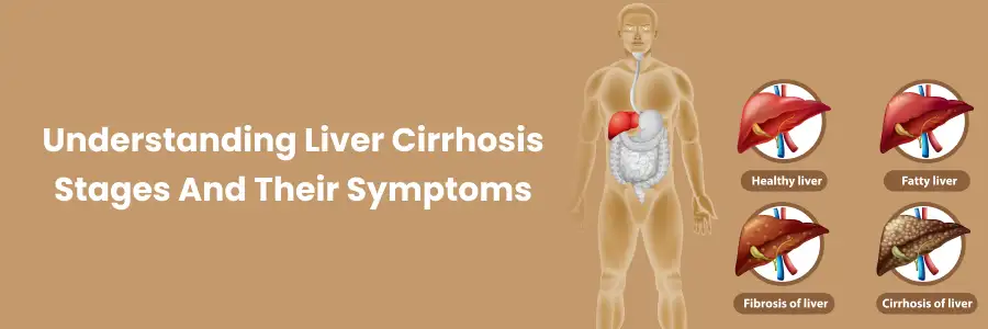 Liver Cirrhosis Stages: Symptoms Overview