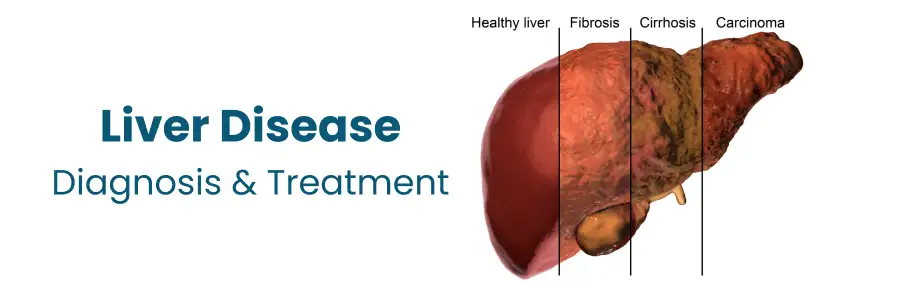 Liver disease diagnosis and treatment