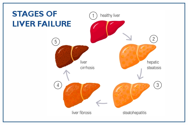 liver-failure