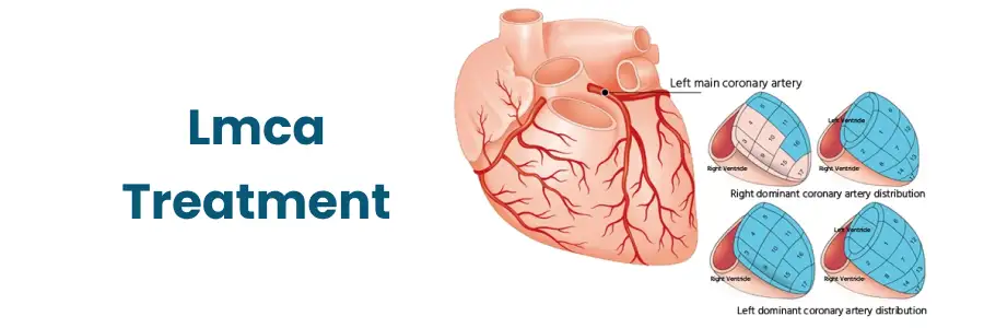 lmca treatment