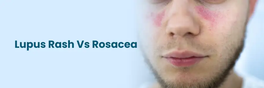 Lupus Rash vs. Rosacea: Vital Contrasts