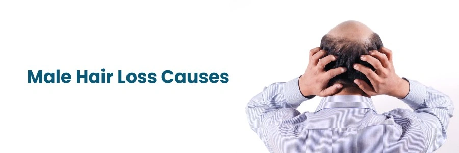 Male Hair Loss Causes: Treatments & Solutions