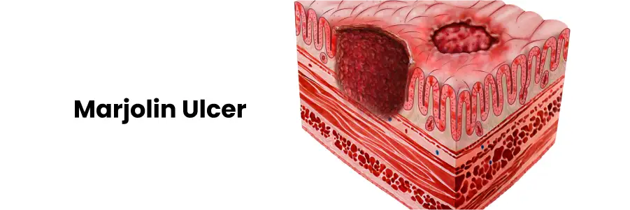 Marjolin Ulcer