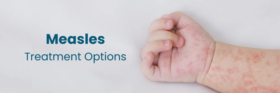 measles treatment options