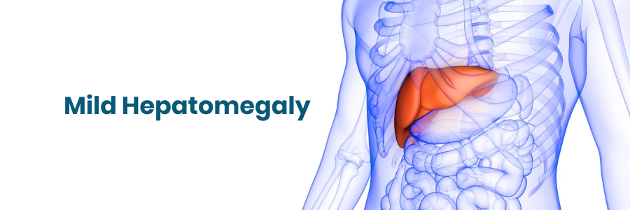 Mild Hepatomegaly