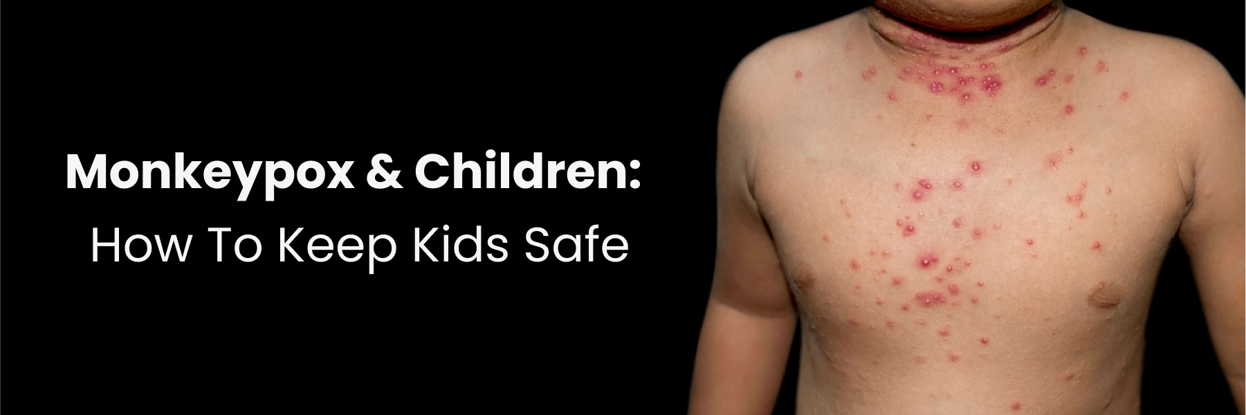 Monkeypox and Children