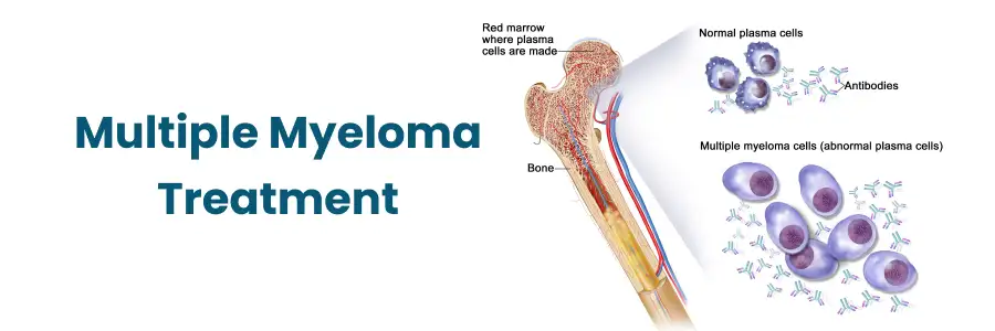 Multiple Myeloma Treatment Begumpet Multiple Myeloma Treatment Begumpet
