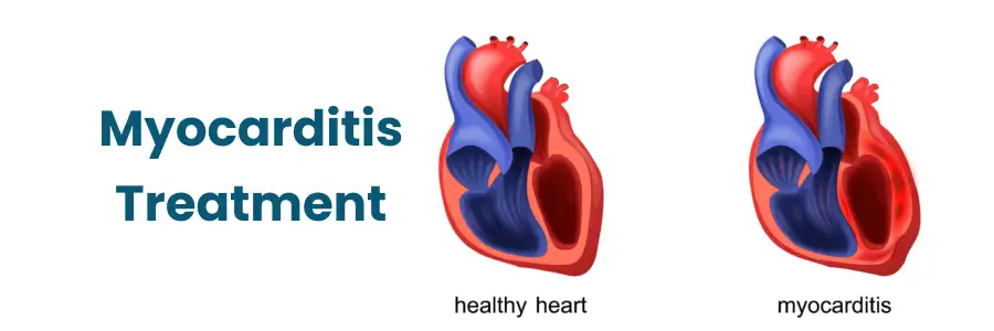 Myocarditis Treatment Begumpet