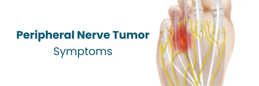 Nerve Tumor Symptoms Nellore Nerve Tumor Symptoms Nellore