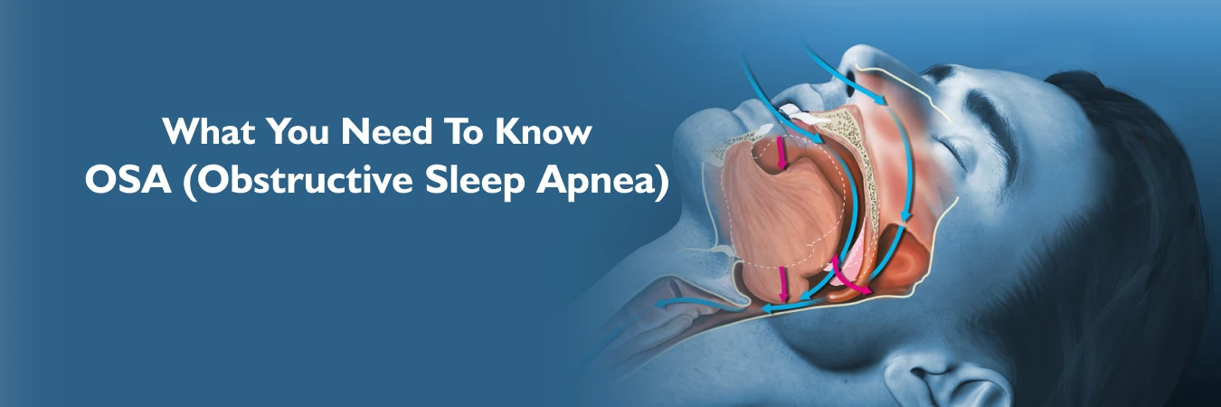 Obstructive Sleep Apnea