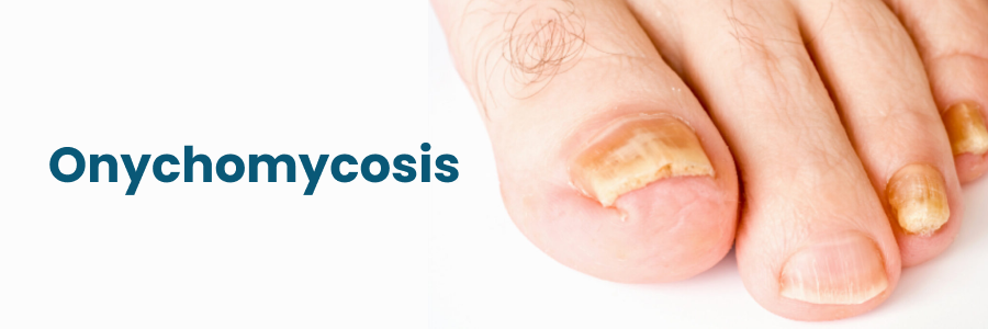 Onychomycosis