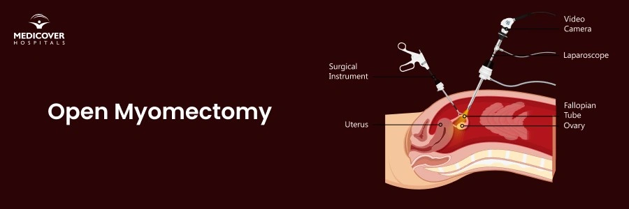 Open Myomectomy in Chandanagar | Fibroid Removal Surgery & Recovery Guide