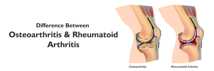 Osteoarthritis vs Rheumatoid Arthritis