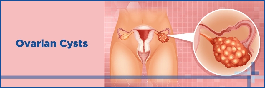 Kystes ovariens : types, symptômes, diagnostic et traitement