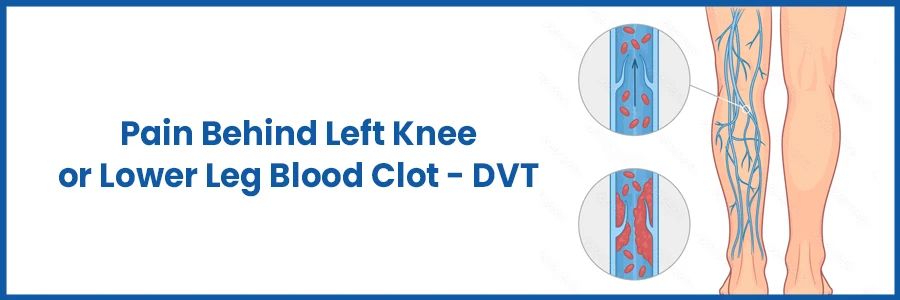 DVT - डाव्या गुडघ्याच्या मागे वेदना किंवा खालच्या पायातील रक्ताच्या गुठळ्या
