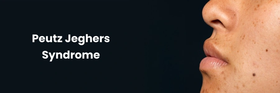 Peutz-Jeghers Syndrome
