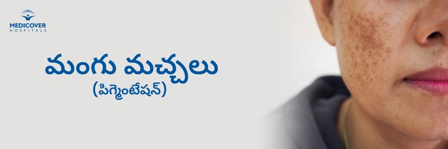 pigmentation-causes-symptoms-types-treatment-telugu