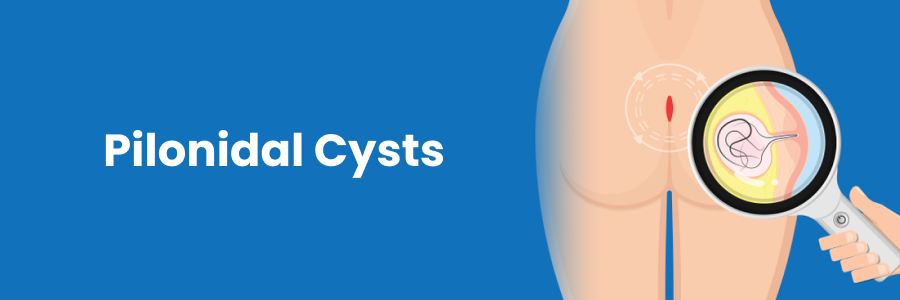 Pilonidal Cysts