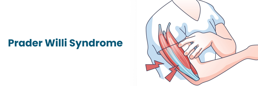 Prader-Willi Syndrome