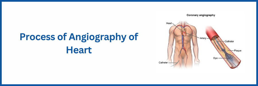Process of angiography of heart