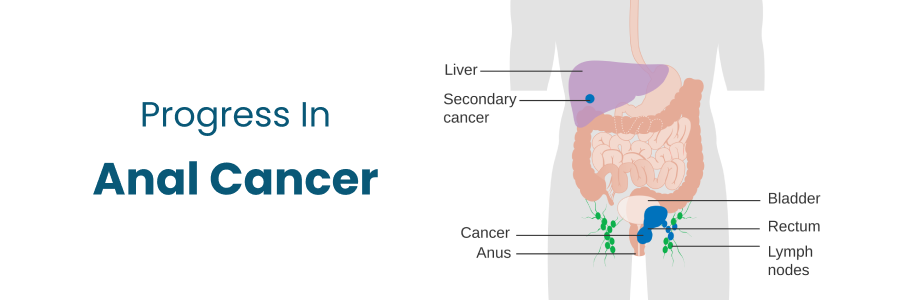 Progress in Anal Cancer From Vizag