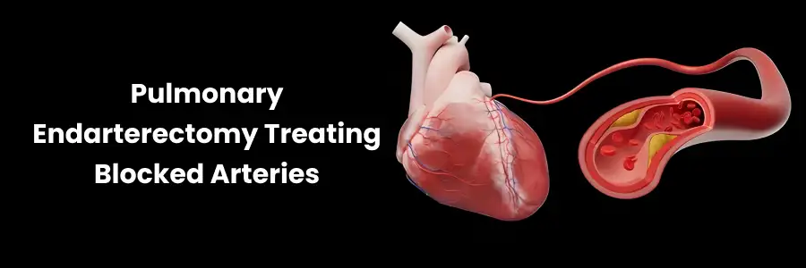"Pulmonary Endarterectomy for Blocked Arteries"